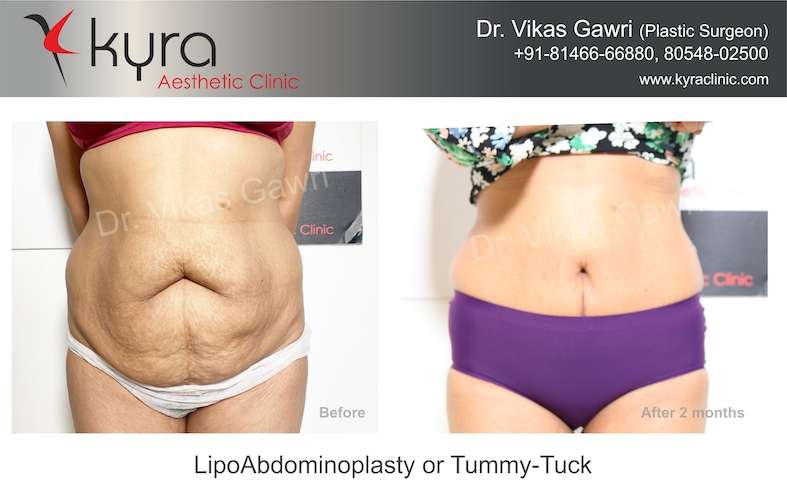 Best Tummy Tuck Surgery in India