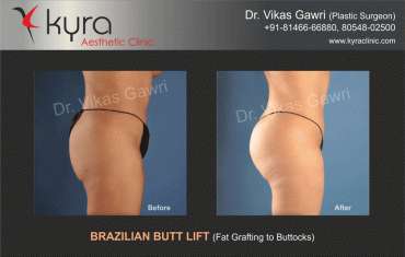 Best Brazilian Butt Lift Surgery in Ambala