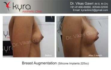 Best Breast Augmentation – Implants in Sahibzada Ajit Singh Nagar