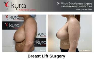 Best Breast Lift Surgery in Sahibzada Ajit Singh Nagar