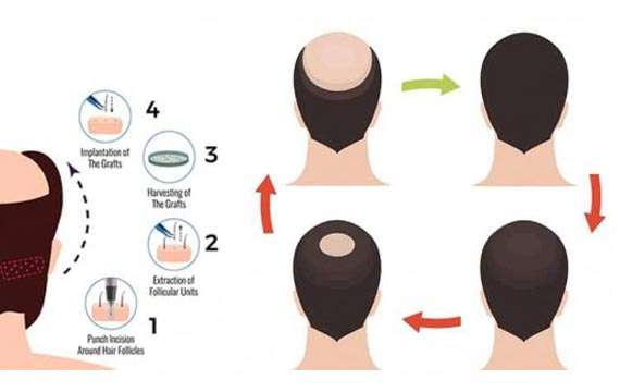 Best PRP Treatment  for Hair Loss in Vancouver