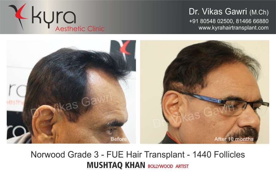 Hair Transplant in Amritsar, Hair Transplant Cost in Amritsar