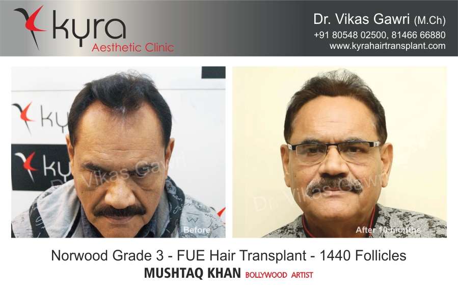 Hair Transplant in Ludhiana, Hair Transplant Cost in Ludhiana, India