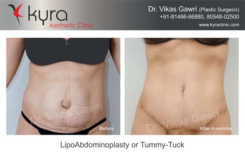 Tummy Tuck Surgery in Kurukshetra, Abdominoplasty in Kurukshetra