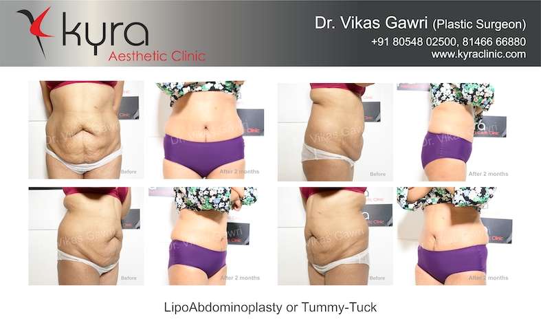 Comparison Between Liposuction and Tummy Tuck - AllureMedSpa