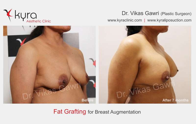 Fat Transfer Breast Augmentation Surgery in Edmonton, Fat Grafting Breast  Cost in Edmonton