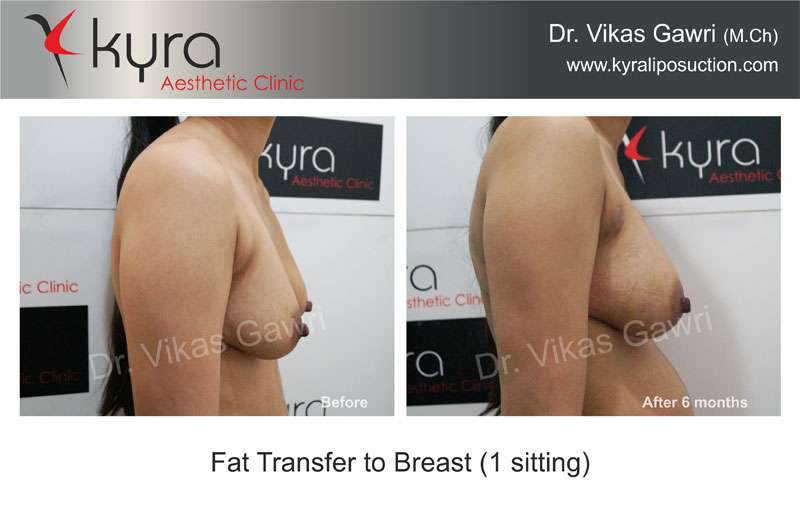 Fat Transfer Breast Augmentation in Ludhiana, Fat Grafting Breast Cost  Ludhiana, India