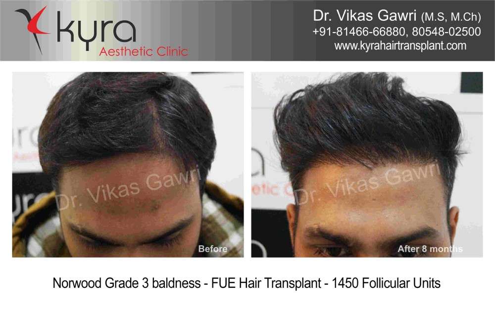 Hair Transplant in Pathankot, Hair Transplant Cost in Pathankot