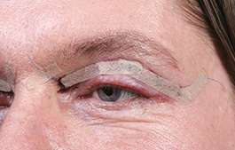 View Video(s) of BLEPHAROPLASTY