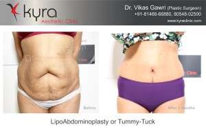 Best Abdominoplasty / Tummy Tuck in India