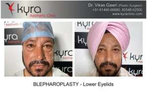 Best Blepharoplasty Surgery in Delhi