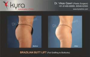 Best Brazilian Butt Lift in India