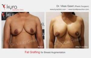 Best Breast Augmentation – Fat Transfer in India