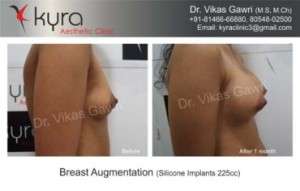 Breast Augmentation – Implants in Ludhiana