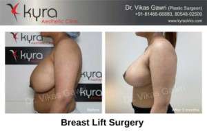 Breast Lift Surgery in Ludhiana