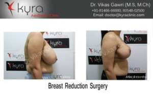 Best Breast Reduction Surgery in Delhi