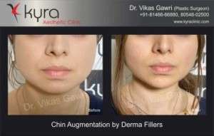 Best Chin Augmentation Surgery in Pathankot