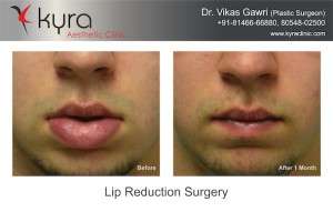 Best Lip Reduction Surgery in Punjab