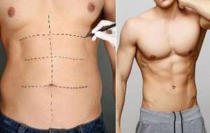 Best Liposuction in India
