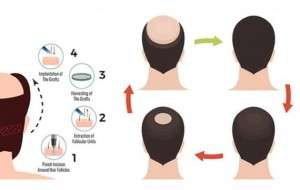Best PRP Treatment  for Hair Loss in Srinagar