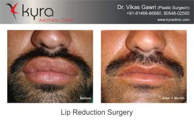View Photo(s) of Lip Reduction Surgery