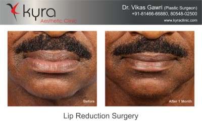 Lip Reduction Surgery