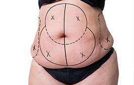 View Photo(s) of LIPOSUCTION FEMALE