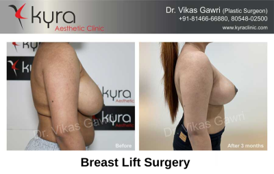 View Photo(s) of BREAST LIFT