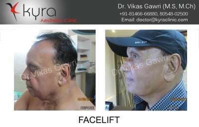 View Photo(s) of FACELIFT